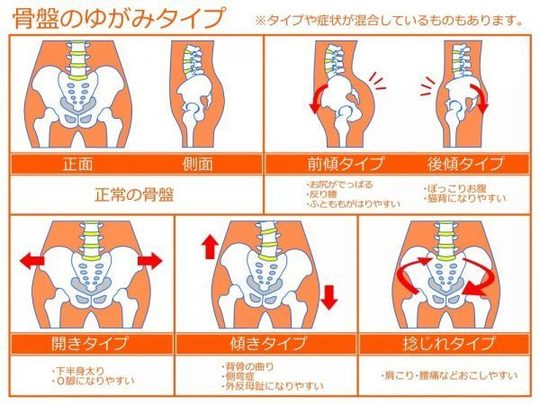 骨盤矯正